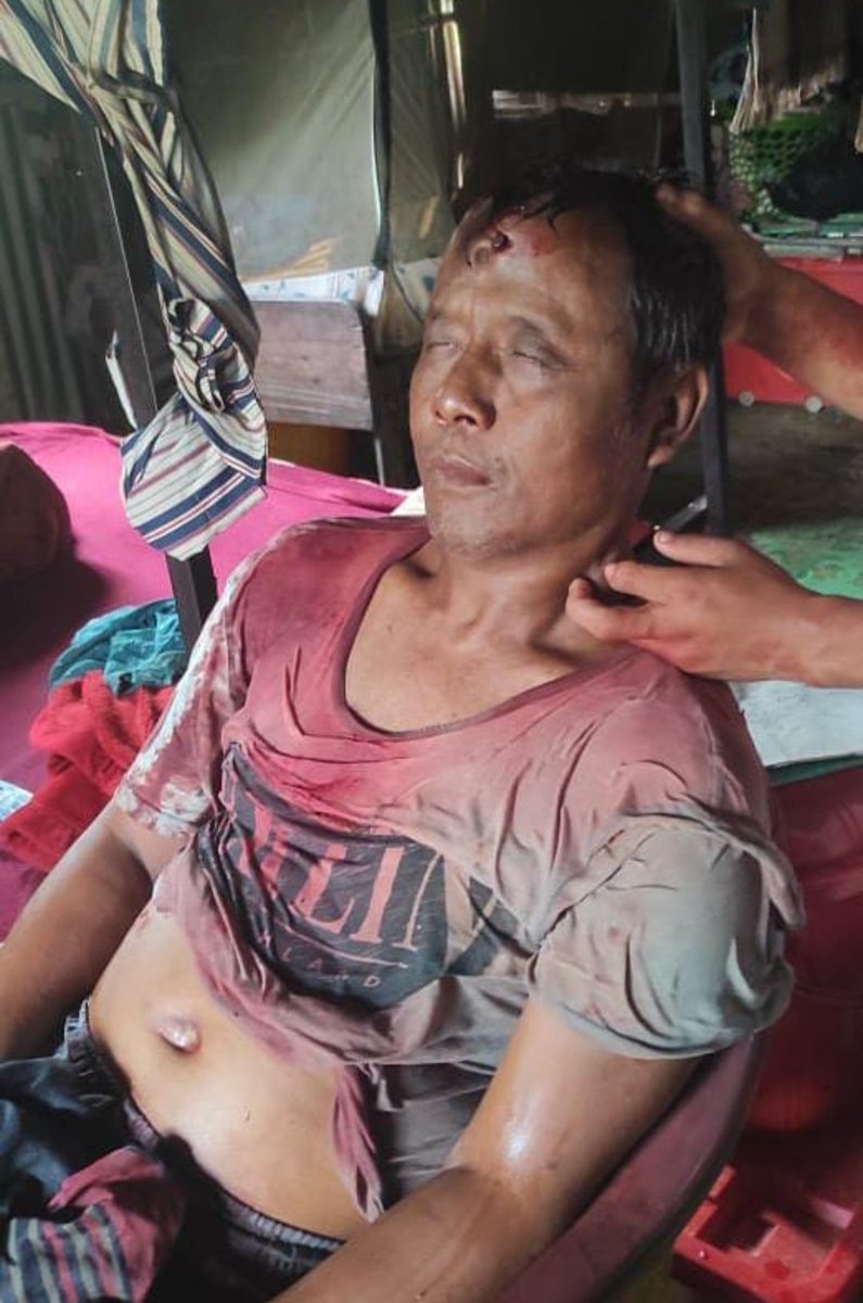 TheKanglei54850's tweet photo. #Kukis Brutality on a #Gangte Tribal

Today, in a scuffle over #Kukiland &amp; #Zoland issue, @Kuki_Inpi volunteers caught a #Gangte tribal volunteers of @ITLFMedia_Cell &amp; nailed him on his forehead.

The man with sever head injuries is taken to #Churachandpur hospital https://t.co/0m50g05H68