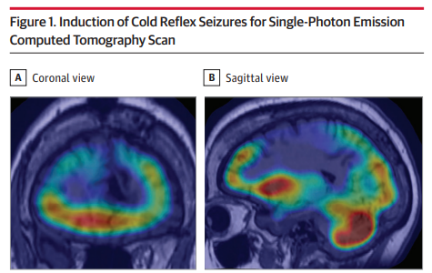 Case report: describes a woman cold-induced reflex seizures. ja.ma/3X1TZH1