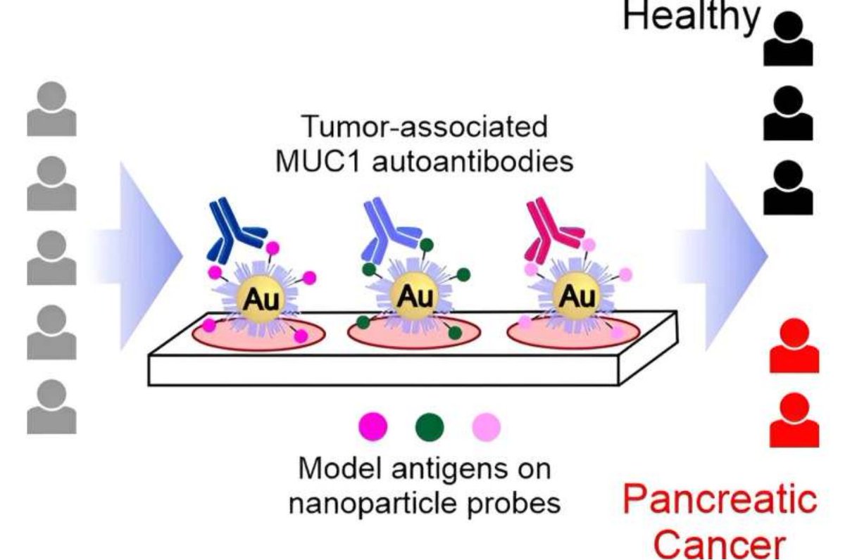 Detection of Tumor-Associated Autoantibodies in the Sera of Pancreatic Cancer Patients Using Engineered MUC1 Glycopeptide Nanoparticle Probes

doi.org/10.1002/anie.2…