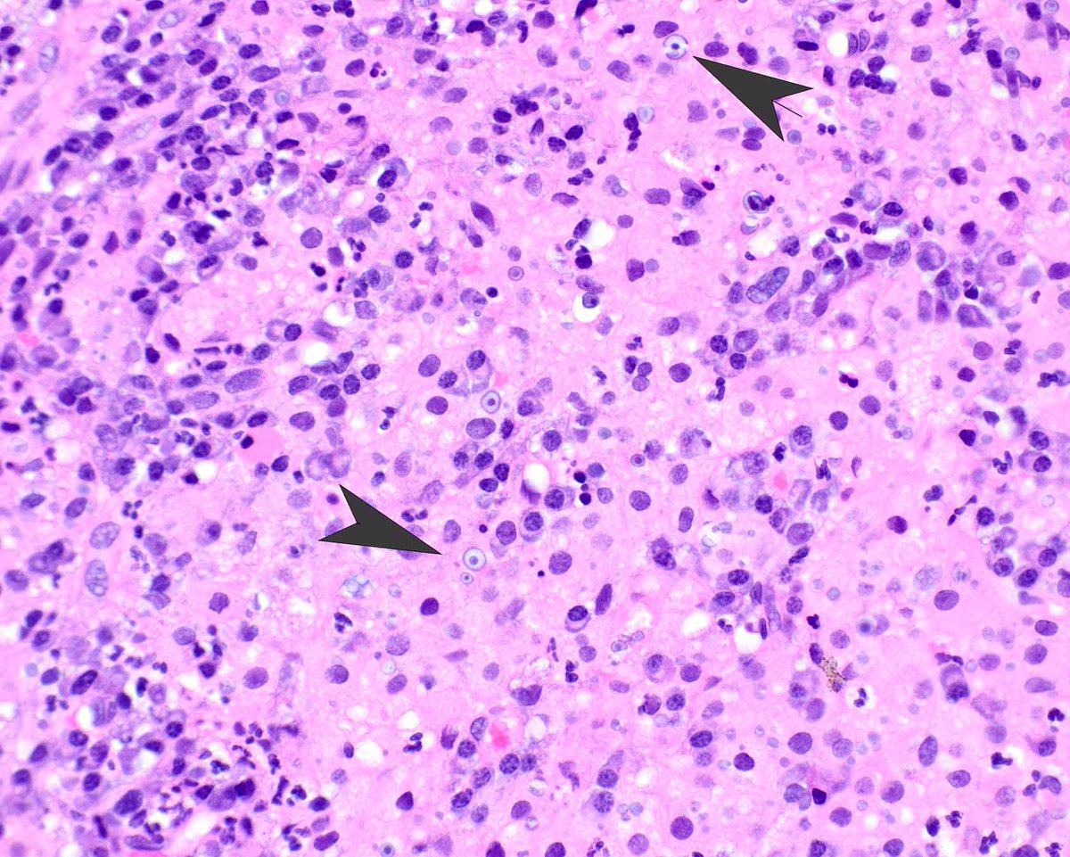 LizMontgomeryMD's tweet photo. This example of colorectal malakoplakia presented as a mass lesion.  The pale pink appearance of the histiocytes is a clue to search for Michaelis-Gutmann bodies. #umiamipath 

Reference:  Am J Surg Pathol. 2020 Sep;44(9):1251-1258. PMID: 32301754. https://t.co/PiDsZgH8Mv