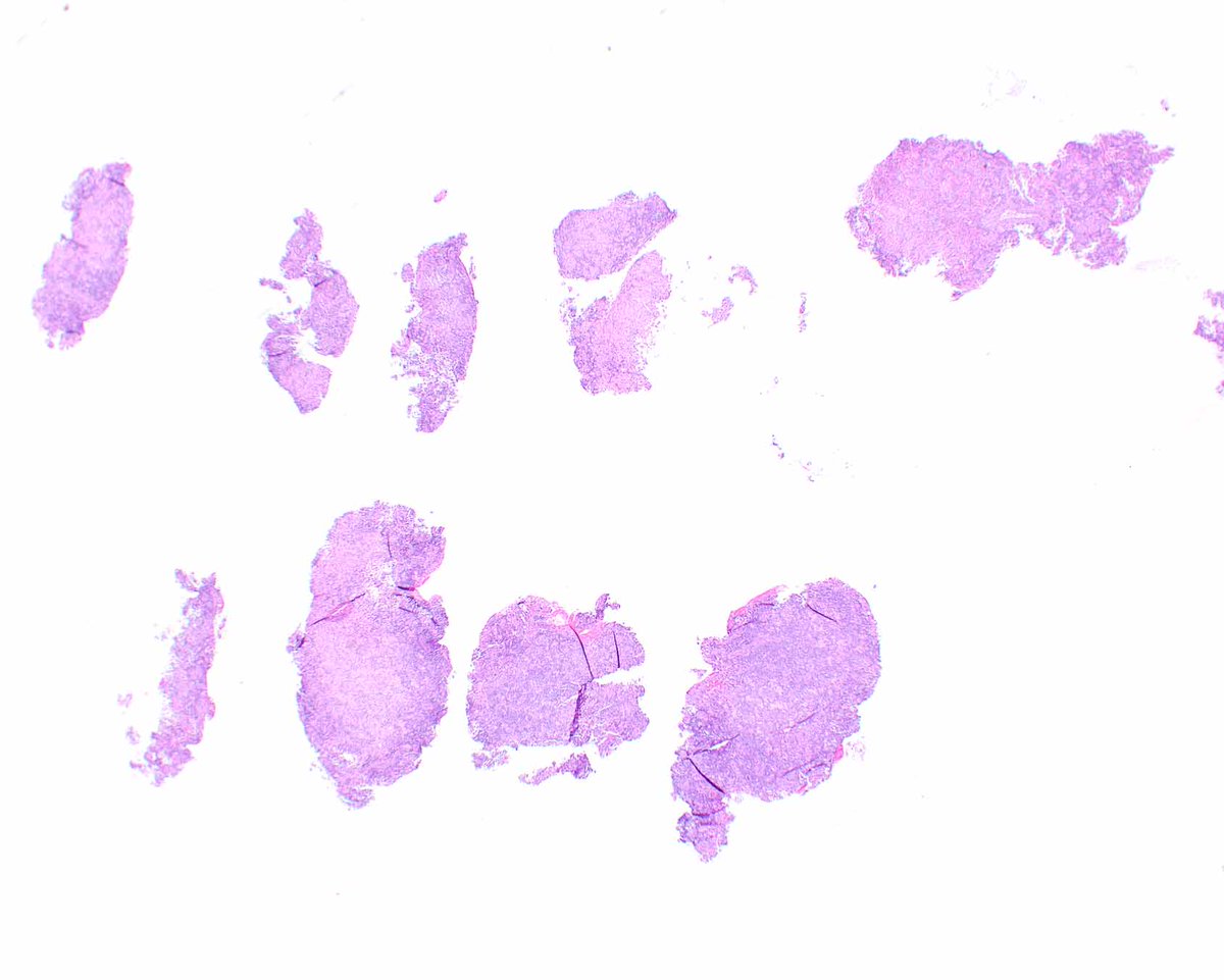 LizMontgomeryMD's tweet photo. This example of colorectal malakoplakia presented as a mass lesion.  The pale pink appearance of the histiocytes is a clue to search for Michaelis-Gutmann bodies. #umiamipath 

Reference:  Am J Surg Pathol. 2020 Sep;44(9):1251-1258. PMID: 32301754. https://t.co/PiDsZgH8Mv