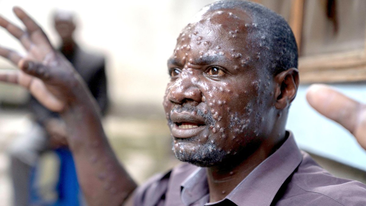 IamDennisOtieno's tweet photo. A significant increase in cases of MPox in Africa. A worrying situation. 

Are we going to see  Western countries closing their  orders to African travellers?. And what lessons did Africa learn from the Covid19 disaster? https://t.co/DLtimkFccH