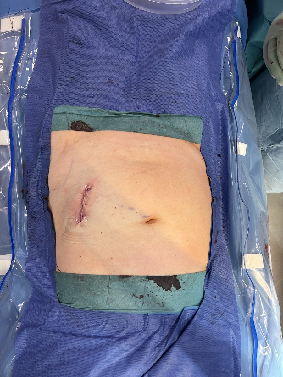 <a href="/chriseden99/">Christopher Eden</a> <a href="/YouTube/">YouTube</a> So exciting to be able to offer this to some of our patients <a href="/LondnBridgeHosp/">London Bridge Hospital</a>  with <a href="/chriseden99/">Christopher Eden</a> and <a href="/CahillDeclan/">Declan Cahill</a> A nephro-ureterectomy through just this!