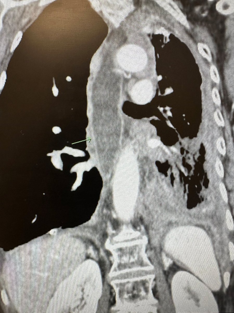 Y C Gary Lee (@ycgarylee) on Twitter photo #PLEURAL_PEARLS_WA 24
Obstructed esophagus/total dysphagia from extrinsic #mesothelioma compression is among the worst complications of this cancer. Look out for dysphagia; refer early for dilatation/stenting <a href="/PleuralPOCUS/">Alejandro</a> <a href="/TheRACP/">The Royal Australasian College of Physicians</a> <a href="/RCPhysicians/">Royal College of Physicians</a> <a href="/CR_UK/">Cancer Research UK</a> <a href="/RCRadiologists/">The Royal College of Radiologists</a> <a href="/Mesouk/">Mesothelioma UK</a> #PLEURAL_PEARLS_WA 24
Obstructed esophagus/total dysphagia from extrinsic #mesothelioma compression is among the worst complications of this cancer. Look out for dysphagia; refer early for dilatation/stenting <a href="/PleuralPOCUS/">Alejandro</a> <a href="/TheRACP/">The Royal Australasian College of Physicians</a> <a href="/RCPhysicians/">Royal College of Physicians</a> <a href="/CR_UK/">Cancer Research UK</a> <a href="/RCRadiologists/">The Royal College of Radiologists</a> <a href="/Mesouk/">Mesothelioma UK</a>