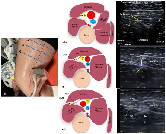 OPEN ACCESS ARTICLE: Ultrasound imaging of the femoral and saphenous nerves
onlinelibrary.wiley.com/doi/10.1002/aj…