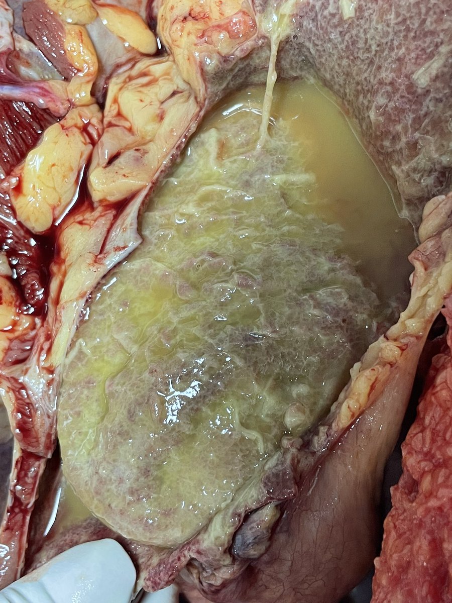 rqbittenc's tweet photo. 35 yo, chest pain. Whats you diagnosis?

#pathology #cardio #heart #heartpath #pathresidents #autopsy #autopsypath #PathTwitter https://t.co/9nvKgDBPkD