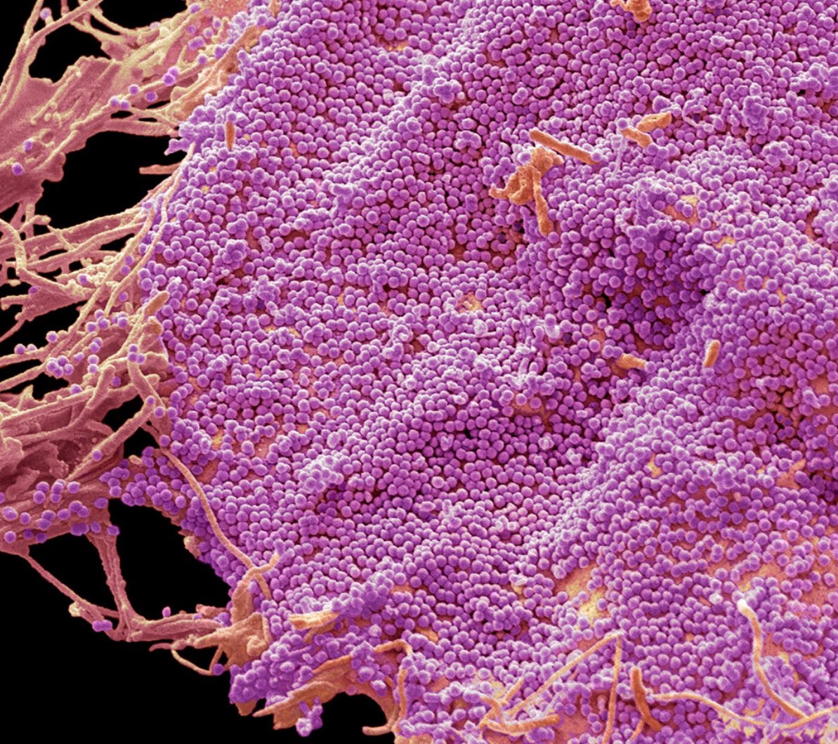 (lilac colored spheres are HIV on an infected cell)

I have seen some amazing new developments this year. Unconventional stuff, looking at HIV treatment, HIV reservoirs, and HIV prevention in new ways.

Here is a remarkable study of re-engineered HIV administered in one dose.

A