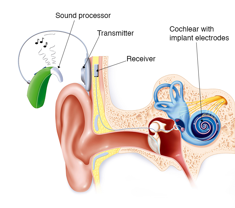 TriviaMonsterTM's tweet image. 🦘 Did You Know? Australia was the first country to develop the bionic ear (cochlear implant) in 1982. This revolutionary device has given the gift of hearing to over 250,000 people worldwide, transforming lives forever. #AustralianFirsts #MedicalBreakthrough #BionicEar
#Trivia