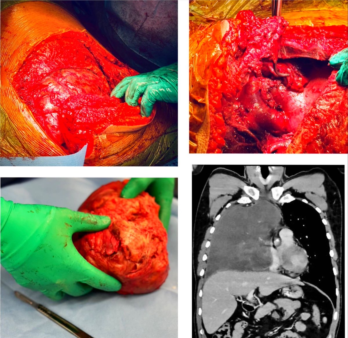 SAOlatam's tweet photo. Resección de tumor germinal mixto primario de mediastino residual post quimioterapia ⁦@rdgzgarciaonco⁩ ⁦@ballantines84⁩ ⁦@cuellarluis⁩ ⁦@Surgicalberserk⁩ https://t.co/iukCGRk3f1