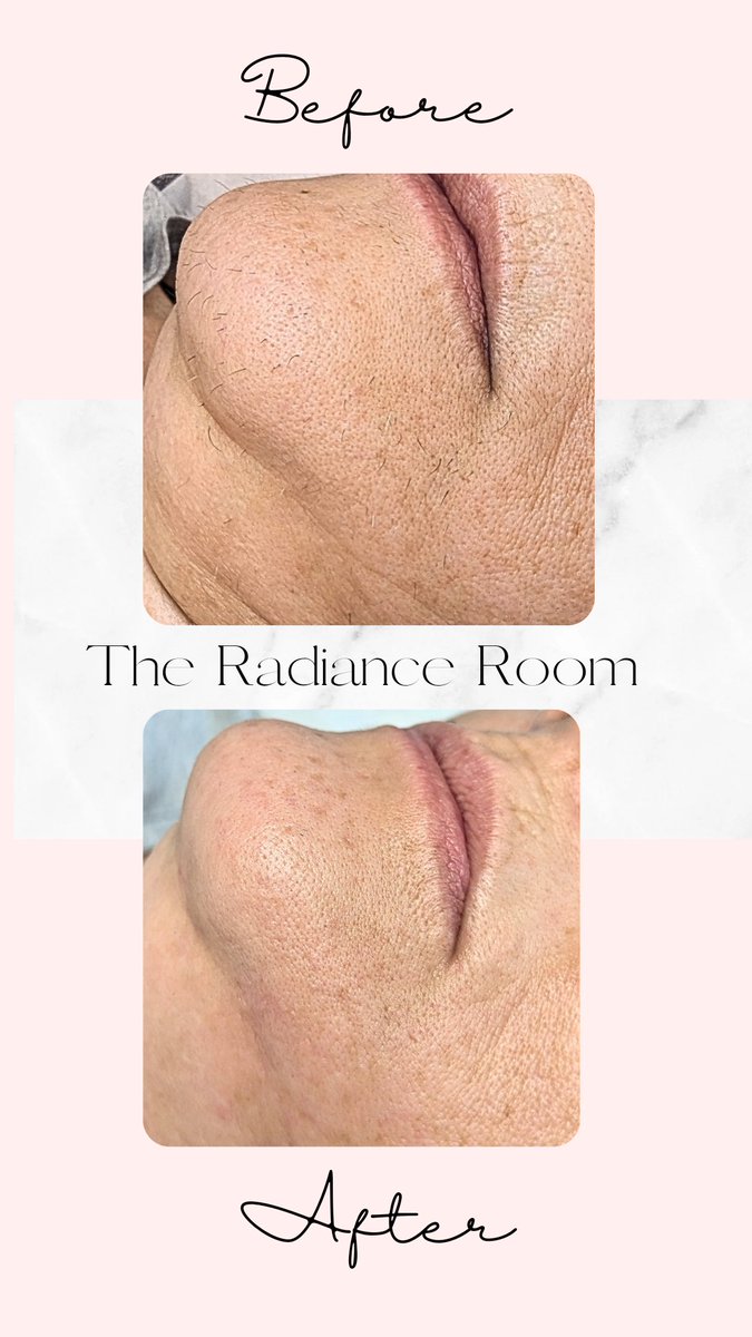 TheRadianceRoom's tweet photo. Hirsutism is excessive hair growth in women. 

@theradianceroom__  used aloe vera hot wax and soothing lavender aftercare lotion from @salonsystem  on my beautiful client just look at those results. 

Hair bye bye ✅
Hello radiant skin ✅
Confidence restored ✅

Book today ✨✅ https://t.co/bO1fTA0Lp1