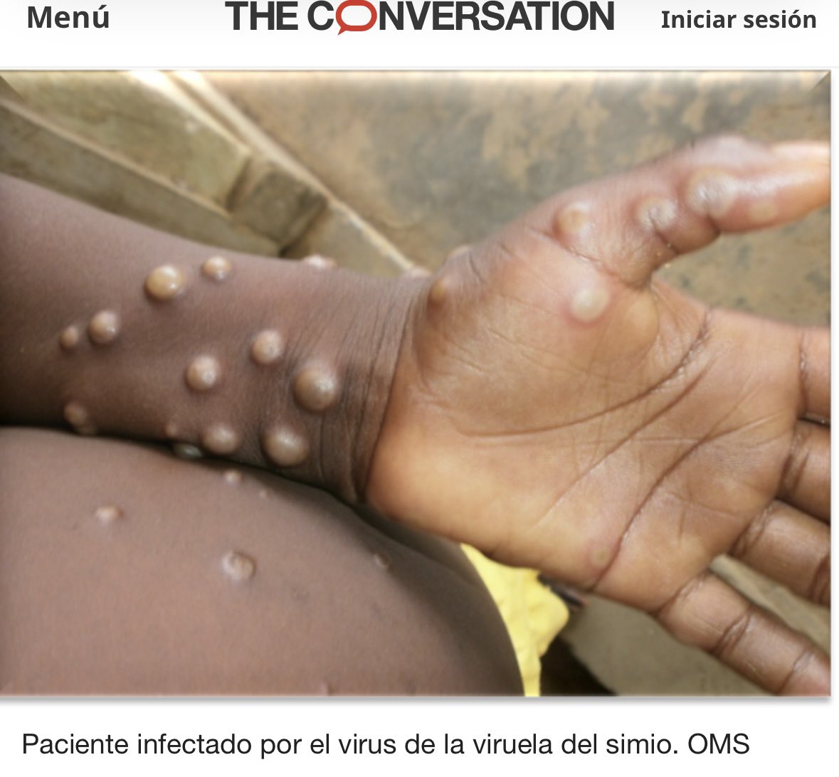 La Viruela del mono, IMPORTANTE‼️

- NO ES HERPES ZÓSTER, es viruela y empieza en la cara, no en órganos internos.

- NO ES VARICELA, las pústulas son duras y profundas, no son superficiales.

- NO ES ENCEFALITIS POR HERPES SIMPLE: se desarrolla en la piel, no se desarrolla a