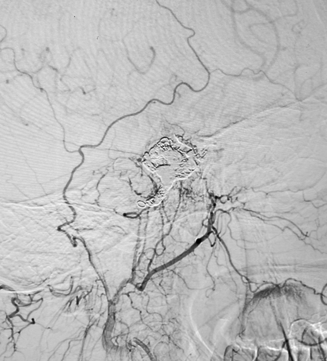 Type D CCF - Successful completion of embolization within 60 minutes of transvenous approach.