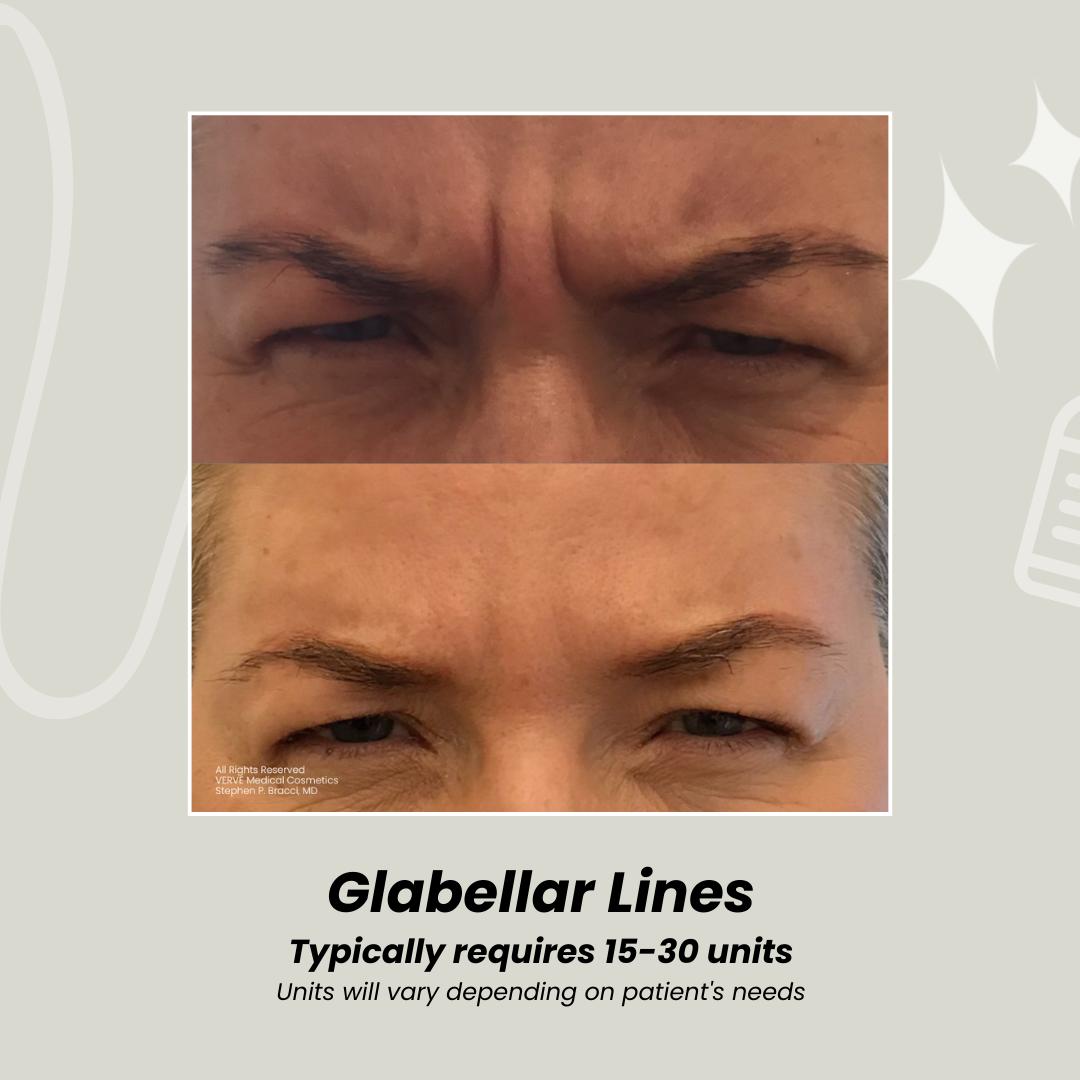 VerveCosmetics's tweet photo. Thinking about Botox but unsure how much you need? 🤔 From smoothing forehead lines to tackling crow’s feet, here’s a quick guide to dosages:

https://t.co/TGYs1fYEEQ https://t.co/MiY1XZUNcZ