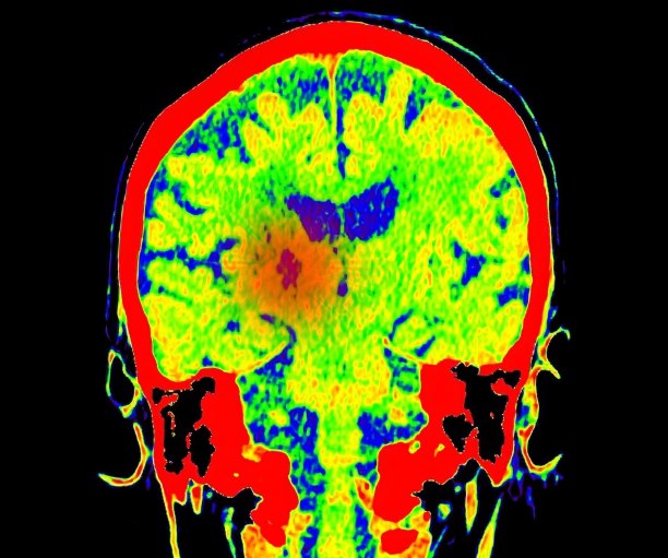 Normothermic regional perfusion boosted the supply of donor organs, but the practice remains controversial from an ethical perspective. Bioethicists weigh in: bit.ly/4cmBhy4

#NeuroTwitter #OrganDonation <a href="/MottChildren/">C.S. Mott Children's</a> <a href="/parent_brendan/">Brendan Parent</a> <a href="/rubinm214/">Michael Rubin</a> <a href="/MattKirschen/">Matt Kirschen</a> <a href="/GeiselMed/">Geisel School of Medicine at Dartmouth</a>