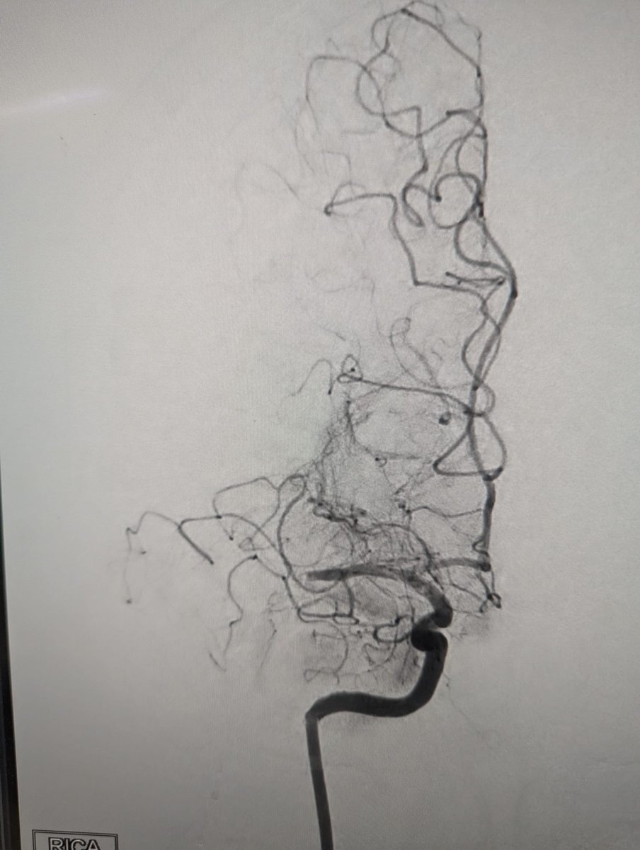 RLHINR's tweet photo. First European outing of the @JNJMedTechUKI #Emboguard #BGC. 

Complete @JNJMedTech stroke solution with #Cereglide &amp; #Embotrap3

#TICI3 #FPE
Patient NIH drop from 14 to 3!

Fantastic new kit to #strikeoutstroke https://t.co/Hkcw83lWEe