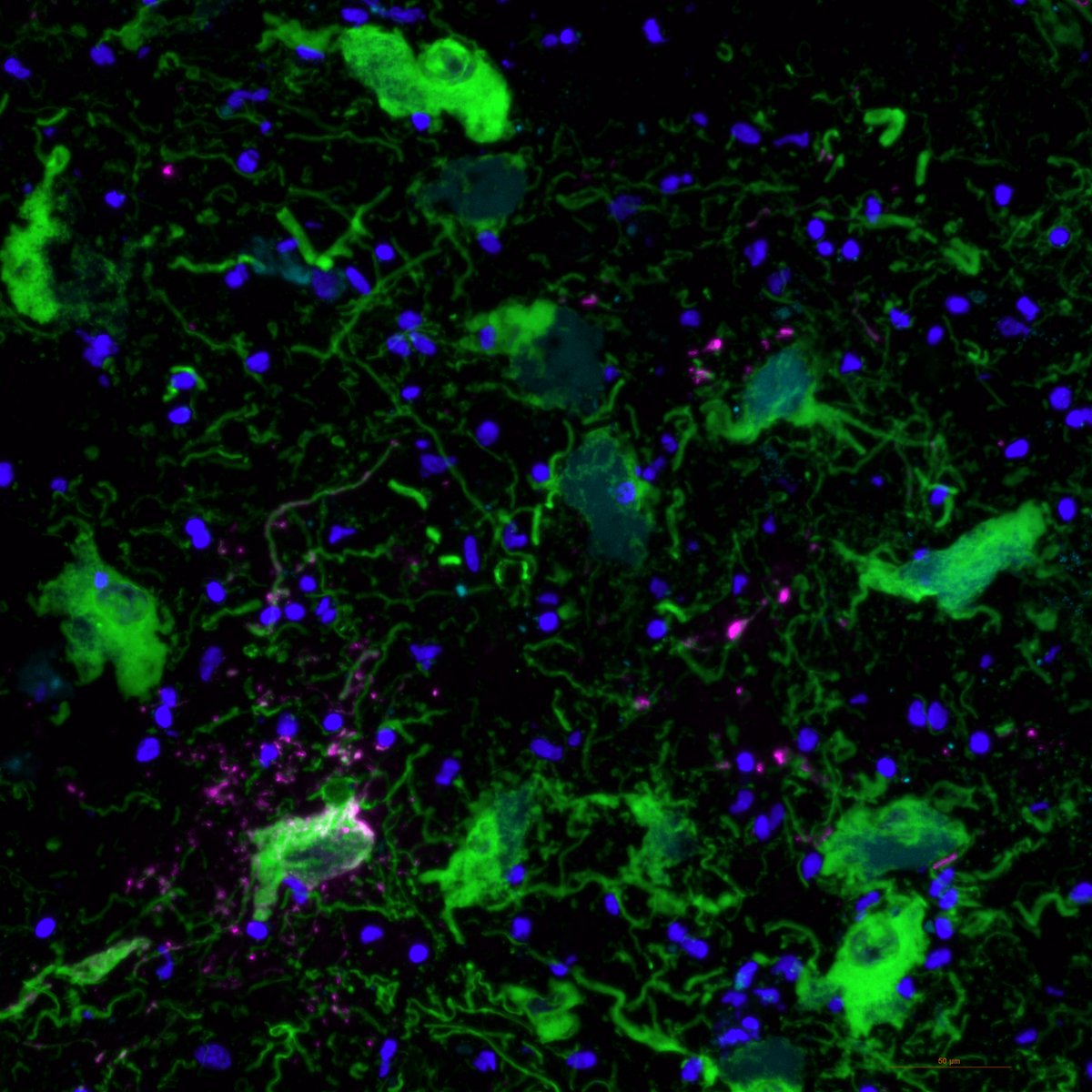 For #FluorescenceFriday - labeling norepinephrine neurons in the human locus coeruleus with tyrosine hydroxylase 🟢, and some Tau accumulation starting (there is no magenta circle emoji). Image credit to <a href="/HeenaDivecha/">Heena Divecha</a> 🔬👩‍🔬💙
