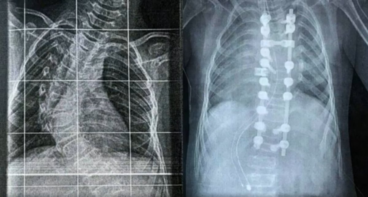 Nemours's tweet photo. Born with Osteogenesis Imperfecta, Paula traveled from Spain to receive treatment for her #scoliosis at Nemours Children’s Hospital, Delaware. Together, our International Medicine and Orthopedics teams collaborated to transform her life. Watch her story: https://t.co/xxhdspQl8q https://t.co/E88JgMG5pD