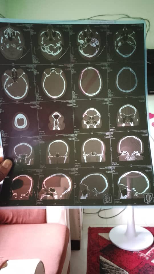 I hope this message finds you well. Someone is in need of help - she has been battling BRAIN CANCER since 2022 and now needs to go to India for surgery. Sadly, she is unable to afford the procedure, and I‘m reaching out for support on her behalf.

Momo - Joynel Ngum: 670750545