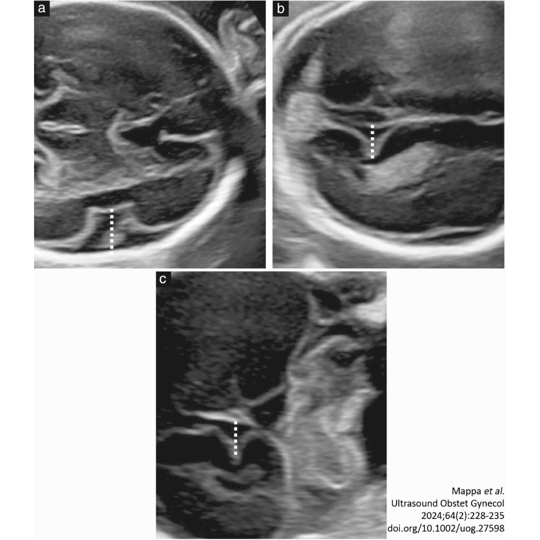 #UOGJournal study of Mappa et al shows that fetuses with late-onset FGR exhibit smaller measurements of midline structures and cortical fissures compared with appropriate- and small-for-gestational-age fetuses. Read the article here: bit.ly/3YJ4ss7