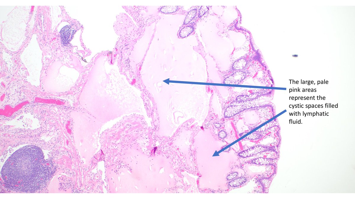 🔬 Colonic Lymphangioma Overview:
•Primary (Congenital): Arises from malformation of lymphatic vessels.
•Secondary (Acquired): Associated with tumor, surgery, or inflammation.

#PathTwitter  #Lymphangioma  #Pathology
