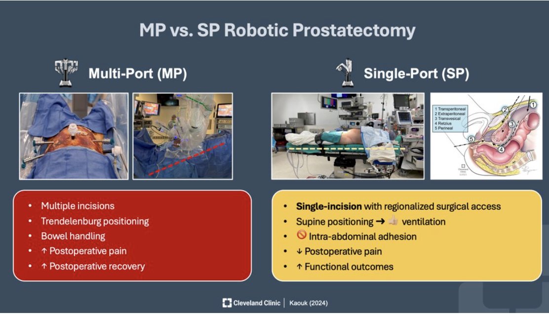 UroToday.com (@urotoday) on Twitter photo Extraperitoneal and transvesical approaches to SP RALP. Presentation by <a href="/Dr_JihadKaouk/">Dr. Jihad Kaouk</a> <a href="/CleClinicMD/">Cleveland Clinic MD</a> and <a href="/NelsonNelsonr2/">Ryan Nelson</a>. #WCET24 written coverage by <a href="/amirlavasani_/">Seyed Amiryaghoub M. Lavasani</a> <a href="/UCI_Urology/">UCI Urology</a> on UroToday > bit.ly/3SRKvv8 <a href="/Endo_Society/">Endourological Society</a> <a href="/SocietySURS/">Society of Urologic Robotic Surgeons (SURS)</a> Extraperitoneal and transvesical approaches to SP RALP. Presentation by <a href="/Dr_JihadKaouk/">Dr. Jihad Kaouk</a> <a href="/CleClinicMD/">Cleveland Clinic MD</a> and <a href="/NelsonNelsonr2/">Ryan Nelson</a>. #WCET24 written coverage by <a href="/amirlavasani_/">Seyed Amiryaghoub M. Lavasani</a> <a href="/UCI_Urology/">UCI Urology</a> on UroToday > bit.ly/3SRKvv8 <a href="/Endo_Society/">Endourological Society</a> <a href="/SocietySURS/">Society of Urologic Robotic Surgeons (SURS)</a>