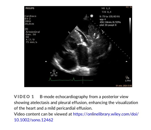 EmergPOCUS's tweet image. 📋 #POCUS y  Evaluación Cardíaca desde una Ventana #Posterior 🫀

- ¿Qué es POCUS? 👉 Point-of-care ultrasound es una herramienta no invasiva que permite realizar diagnósticos y guiar intervenciones directamente en la cama del paciente. 🛏️

🫀 #Ventanas Ecocardiográficas