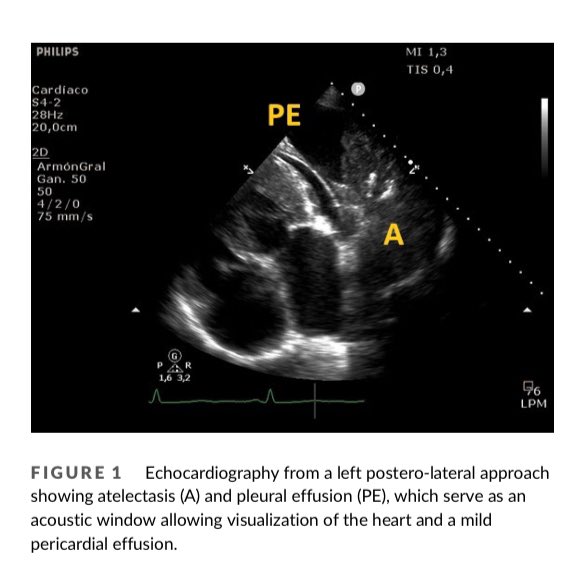 EmergPOCUS's tweet image. 📋 #POCUS y  Evaluación Cardíaca desde una Ventana #Posterior 🫀

- ¿Qué es POCUS? 👉 Point-of-care ultrasound es una herramienta no invasiva que permite realizar diagnósticos y guiar intervenciones directamente en la cama del paciente. 🛏️

🫀 #Ventanas Ecocardiográficas