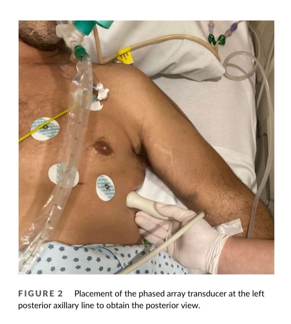 EmergPOCUS's tweet image. 📋 #POCUS y  Evaluación Cardíaca desde una Ventana #Posterior 🫀

- ¿Qué es POCUS? 👉 Point-of-care ultrasound es una herramienta no invasiva que permite realizar diagnósticos y guiar intervenciones directamente en la cama del paciente. 🛏️

🫀 #Ventanas Ecocardiográficas