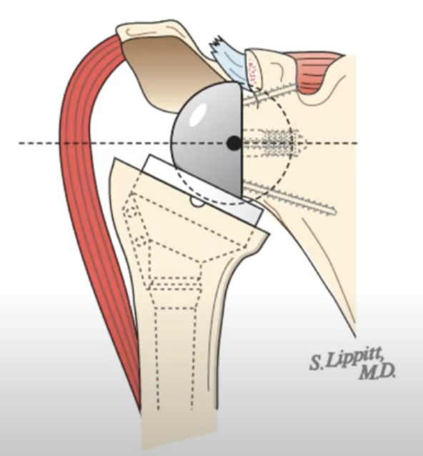 RickMatsen's tweet photo. Incremental value in reverse total shoulder arthroplasty. https://t.co/O2wRGhhguV https://t.co/MVrESbyZbw