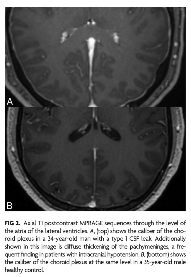 "Volumetric Changes in the Choroid Plexus Associated with Spontaneous Intracranial Hypotension in Patients with Spinal CSF Leak"

doi.org/10.3174/ajnr.A…

#CSFLeak