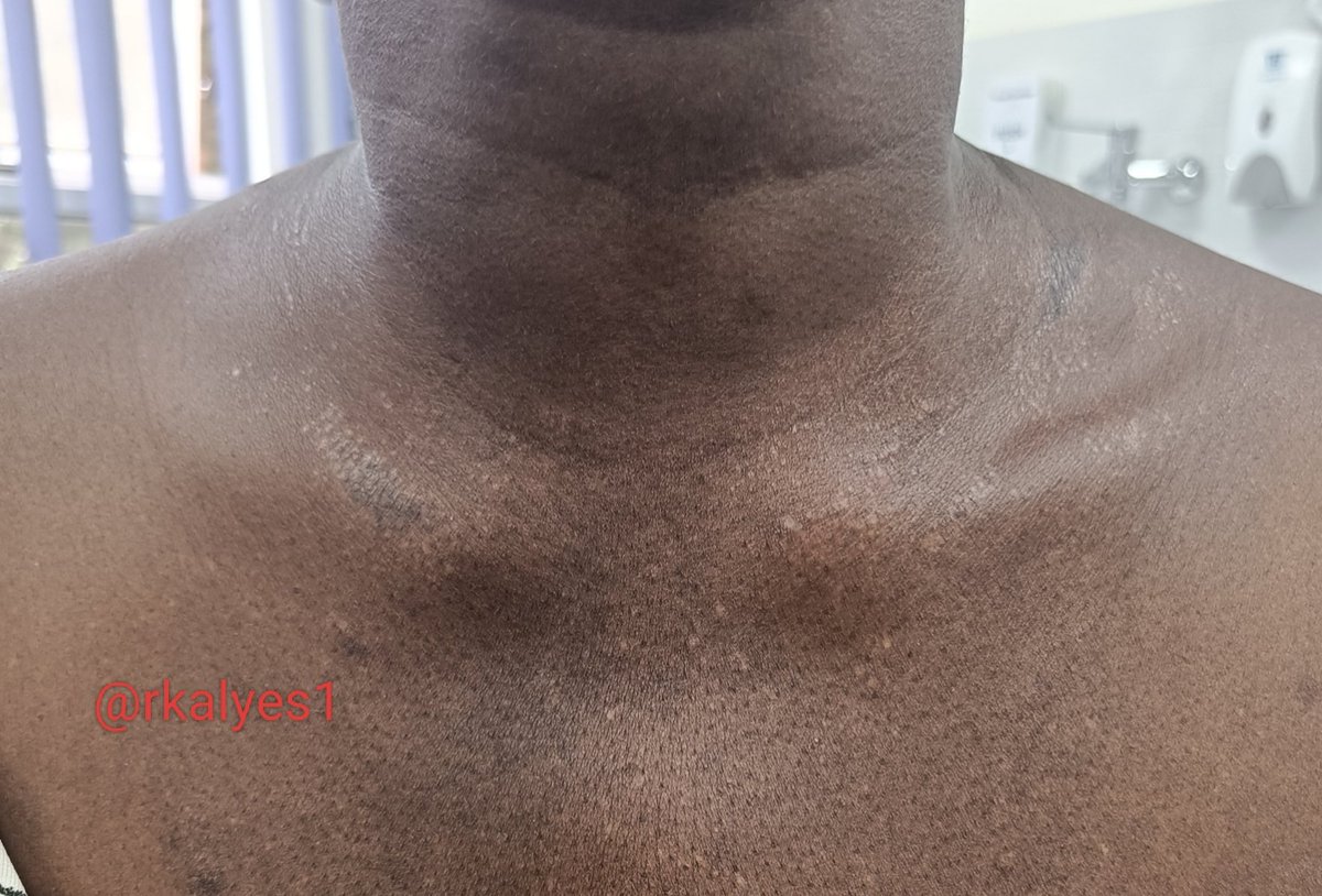 rkalyes1's tweet photo. 🏥 Dr I keep getting an itch and marks around my neck!
Look at the neck ( healing)
👇 What is the diagnosis
#simplecase https://t.co/N0xbT60UeN