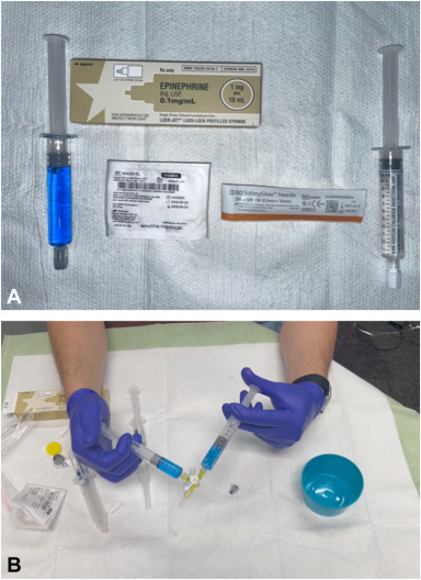 William Hirsch et al try the "Addition of dilute epinephrine to commercially available submucosal lifting agents for cold snare endoscopic mucosal resection" in this Original Article. videogie.org/article/S2468-…

<a href="/BillHirschMD/">William Hirsch</a> <a href="/BilalMohammadMD/">Mohammad Bilal, MD</a> <a href="/NickMcDonaldMD/">Nick McDonald</a>

<a href="/KaraRaphael/">Kara Raphael</a>