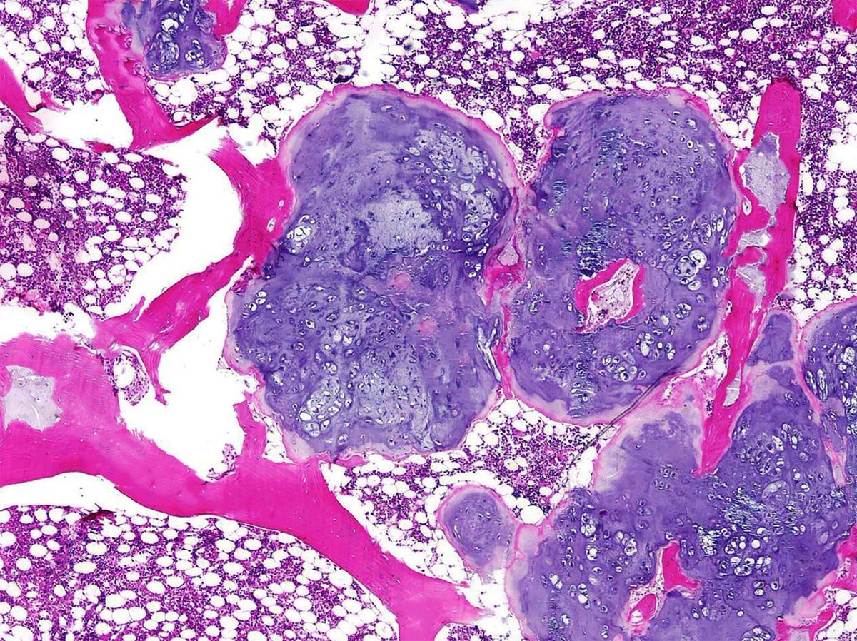 Pathoutlines's tweet photo. Cancer Precursor Project – Characteristics of Premalignant Precursors, Pt 4 (Bone, Joints and Soft Tissue Malignancies)
Essay linked here: https://t.co/AEAGzD6SkD
#PathTwitter #CuringCancerNetwork #CancerResearch #PathologyOutlines https://t.co/pF973hxwAs