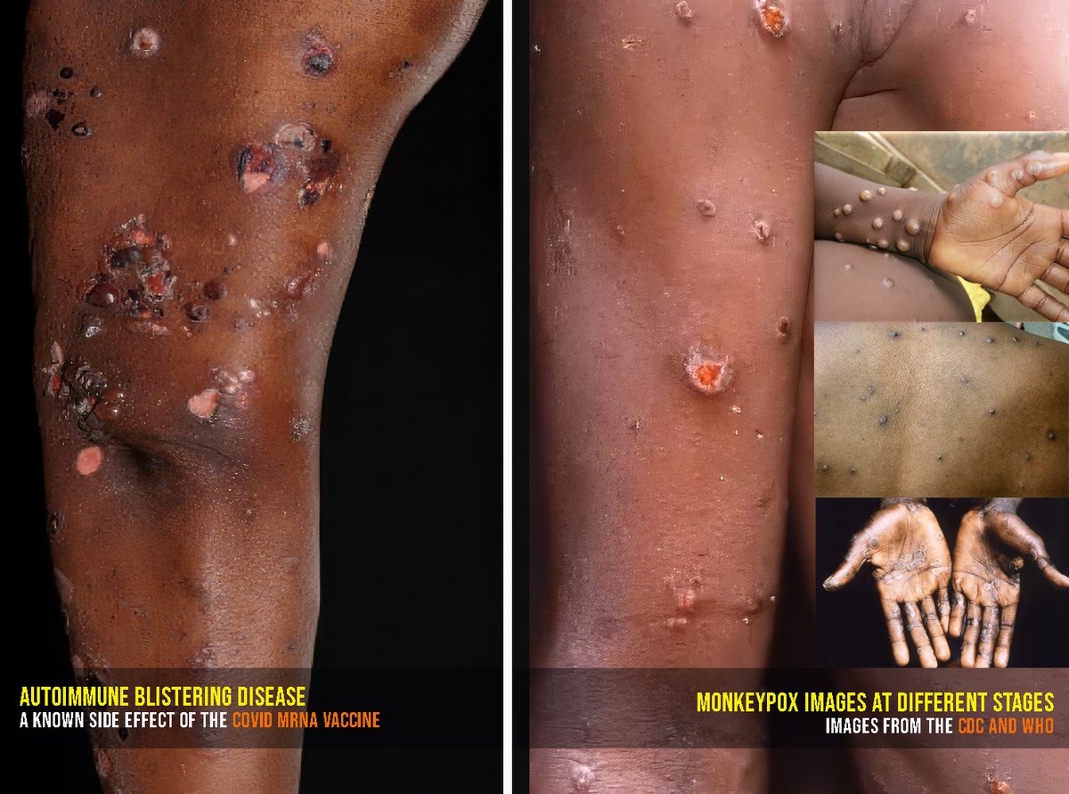 Side by Side
Autoimmune Blistering Disease vs. MonkeyPox

"Autoimmune Blistering Disease" is on the Pfizer list of Adverse Events of Special Interest in their Covid mRNA vaccines, as disclosed in the court-ordered Pfizer Documents. The ones they wanted 72 years to Disclose! lol