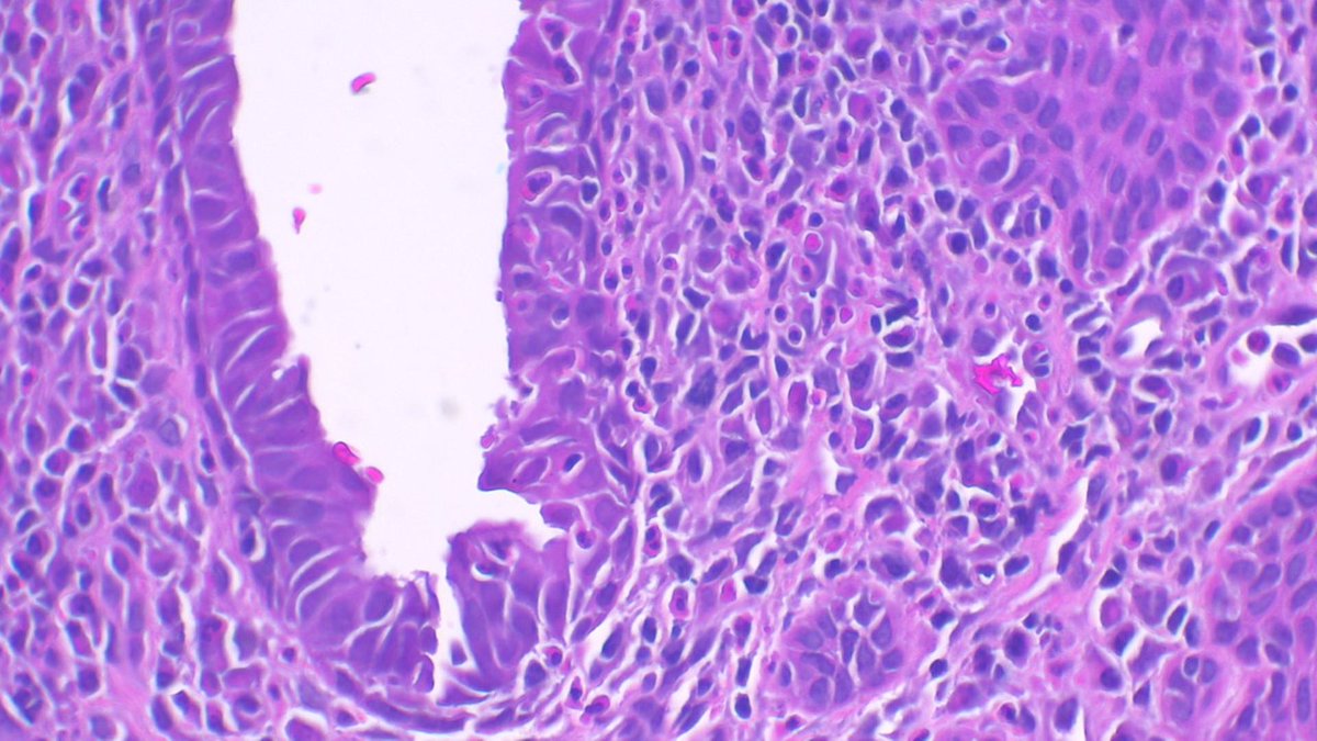 Int Soc Dermpath (@intsocdermpath) on Twitter photo #ISDP #OlympicGames
Spot diagnosis
Case 18 - <a href="/JCandidoXavier/">Jose Candido</a>
SYRINGOCYSTADENOMA PAPILLIFERUM
•It can occur in naevus sebaceus of Jadassohn
•Endophytic crateriform lesion
•Two layers of cells forming papillary and cystic structures
• Numerous plasma cells
#path #derm #ISDP #OlympicGames
Spot diagnosis
Case 18 - <a href="/JCandidoXavier/">Jose Candido</a>
SYRINGOCYSTADENOMA PAPILLIFERUM
•It can occur in naevus sebaceus of Jadassohn
•Endophytic crateriform lesion
•Two layers of cells forming papillary and cystic structures
• Numerous plasma cells
#path #derm