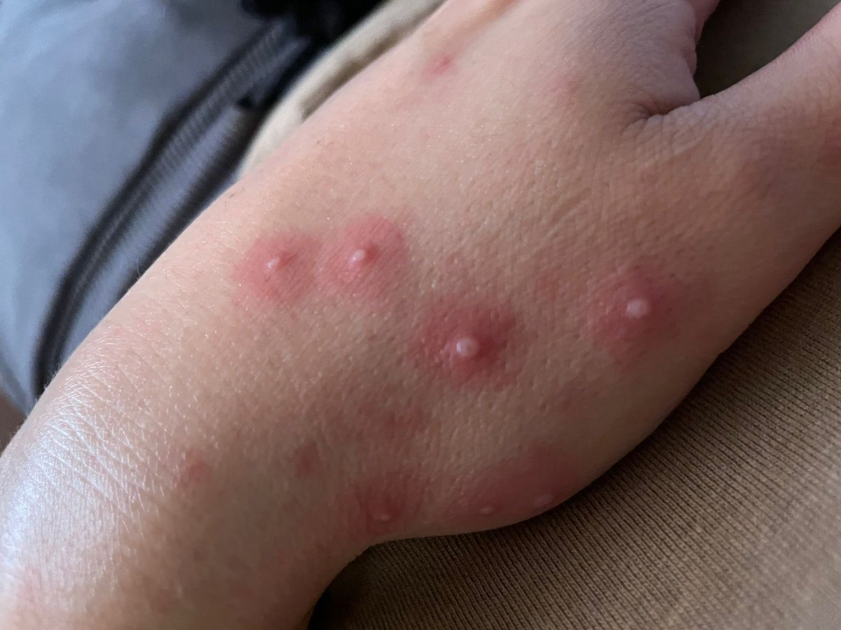 Alainwho's tweet photo. Hace un par de días la @opsoms declaró el #Mpox como epidemia. En México estuvimos organizaciones, colectivas y principalmente personas que vivimos con VIH exigiendo la vacuna que había disponible. El represente en las reuniones de la OPS/OMS dijo (ahí está el vídeo) que era una exageración vacunar, porque después de los sucedido con la COVID-19 había pánico y para todo nos queríamos vacunar. Cc @DKershenobich