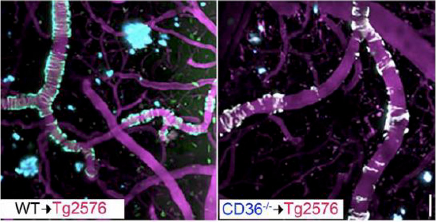 Inflammation from perivascular macrophages and microglia may drive ARIA. #alzheimersdisease ow.ly/Yage50SZMFW