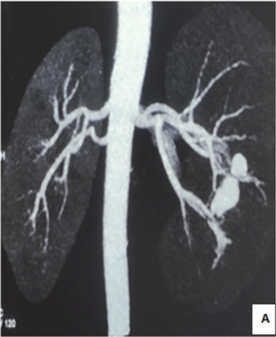 Congratulations to my fellows for an interesting case report in the Medical Journal Armed Forces India about Renal pseudo-aneurysm secondary to trivial abdominal trauma.
Keep on the good work.
authors.elsevier.com/a/1jcCB1Lltrcm…