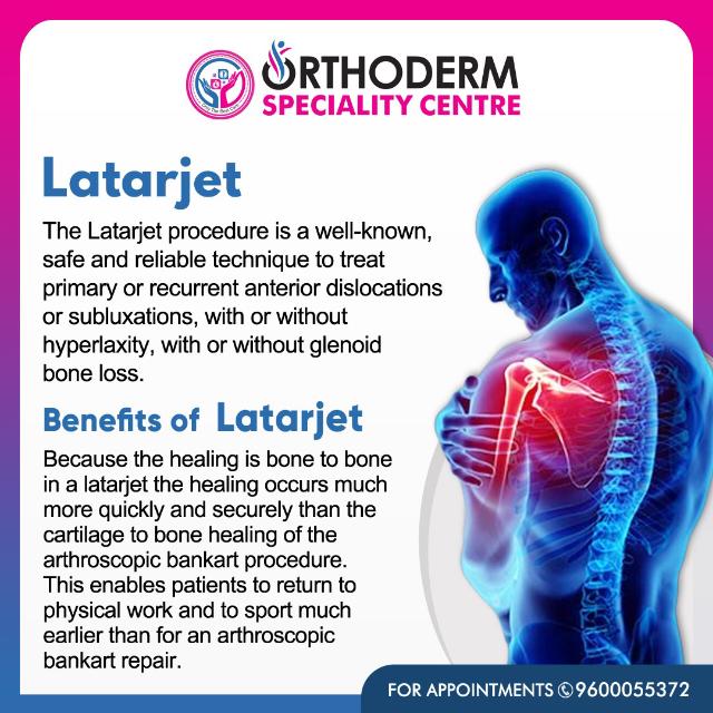 Orthodermcentre's tweet image. 💪 Experiencing recurring shoulder dislocations? The Latarjet procedure might be the solution you&apos;ve been looking for. This advanced surgery can restore stability and get you back to doing what you love.

#LatarjetProcedure #ShoulderStability #OrthopedicSurgery #ShoulderHealth