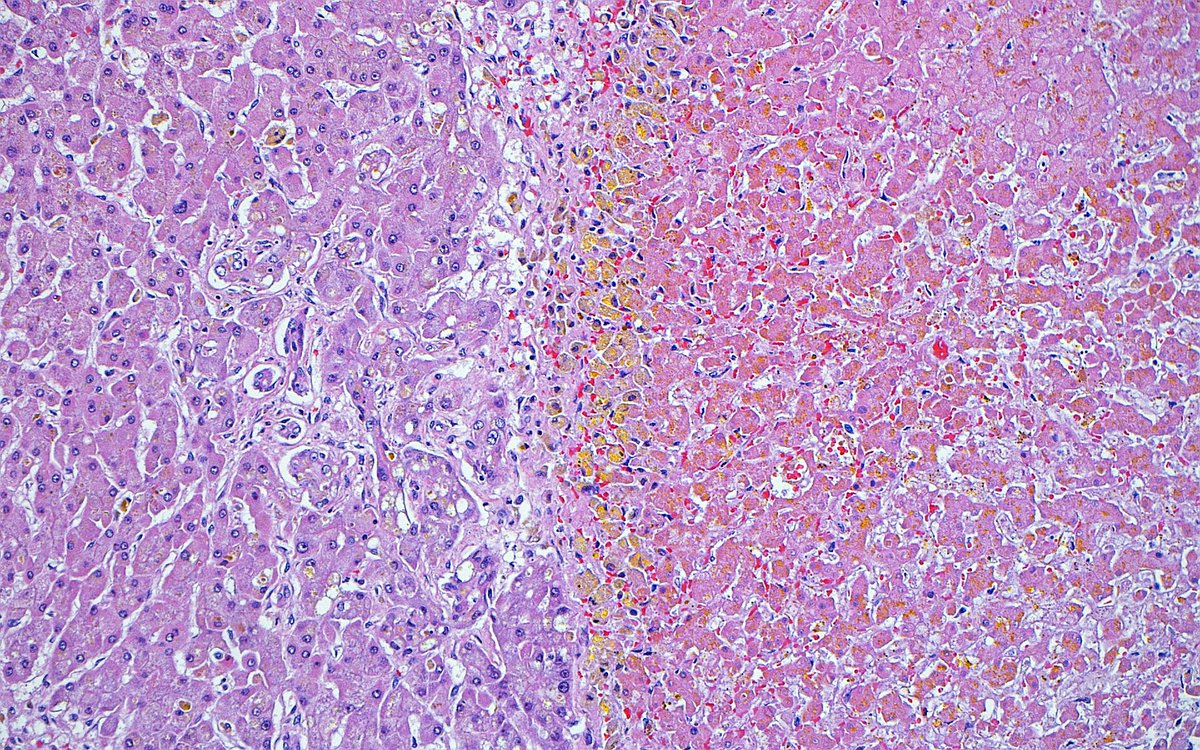 "Edge of destruction" ~ Interface between necrotic (right) and viable (left) liver in a patient treated for hepatocellular carcinoma. #pathology #pathart #liver #liverpathology #hepatology #oncology