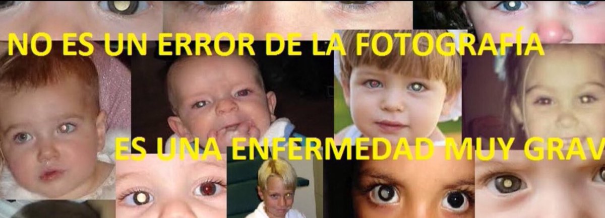 Es día de la #EnfermedadDeCoats o Síndrome de Retinitis Exudativa
Produce pérdida progresiva de la visión, comienza en la niñez y se desarrolla de forma lenta y continua.
El oftalmólogo inglés George #Coats describió en 1908 esta enfermedad crónica idiopática de la retina.