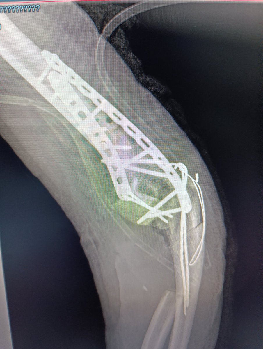 AndrewCmyb's tweet photo. #orthotwitter #traumatwitter #ortho #trauma gunshot humerus fracture with bone defects. ORIF with bone plastics. #ukraine #war https://t.co/3W3fOpfkJz