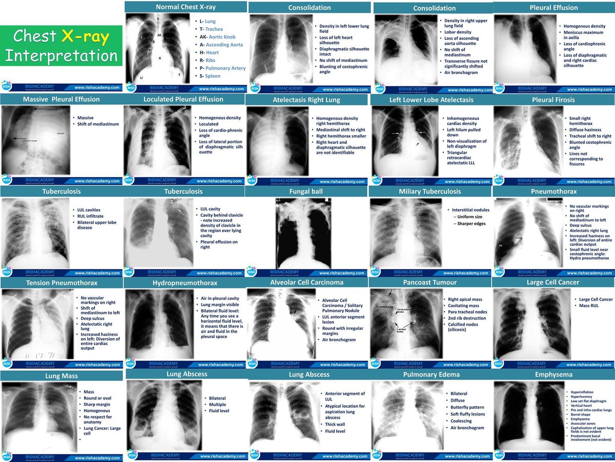 Chest Xray interpretation