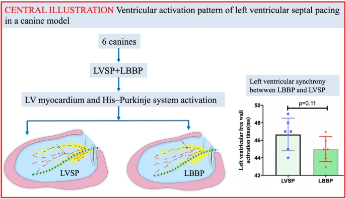 Another nice study showed negligible differences between LBBP and LVSP. 
link.springer.com/article/10.100…