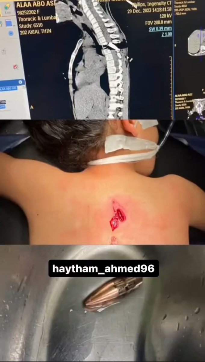 Esta es la espalda de Alaa Abu Aasi, una niña palestina de 9 años, los francotiradores sionistas le dispararon en la columna vertebral, por la espalda, mientras jugaba en la entrada del campo de refugiados de Khan Younis, sur de Gaza.

"Israel" no mata por error, mata por horror.