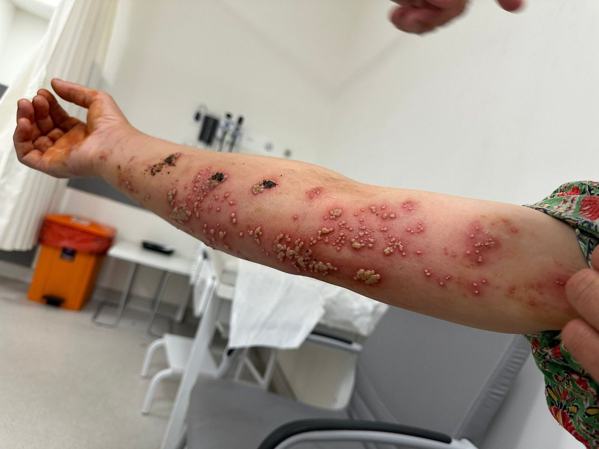 Prof. Dr. Hüsnü Süslü “Ülkemiz için maymun çiçeğine karşı en iyi çözüm önerimiz, ülkemizdeki Afrika kökenli öğrenciler için bir süreliğine uzaktan eğitime geçmektir.” Afrika ülkelerinden en fazla geçişlerin olduğu bir ülke olarak biran önce önlem alınmalıdır.
 #maymunçiceği