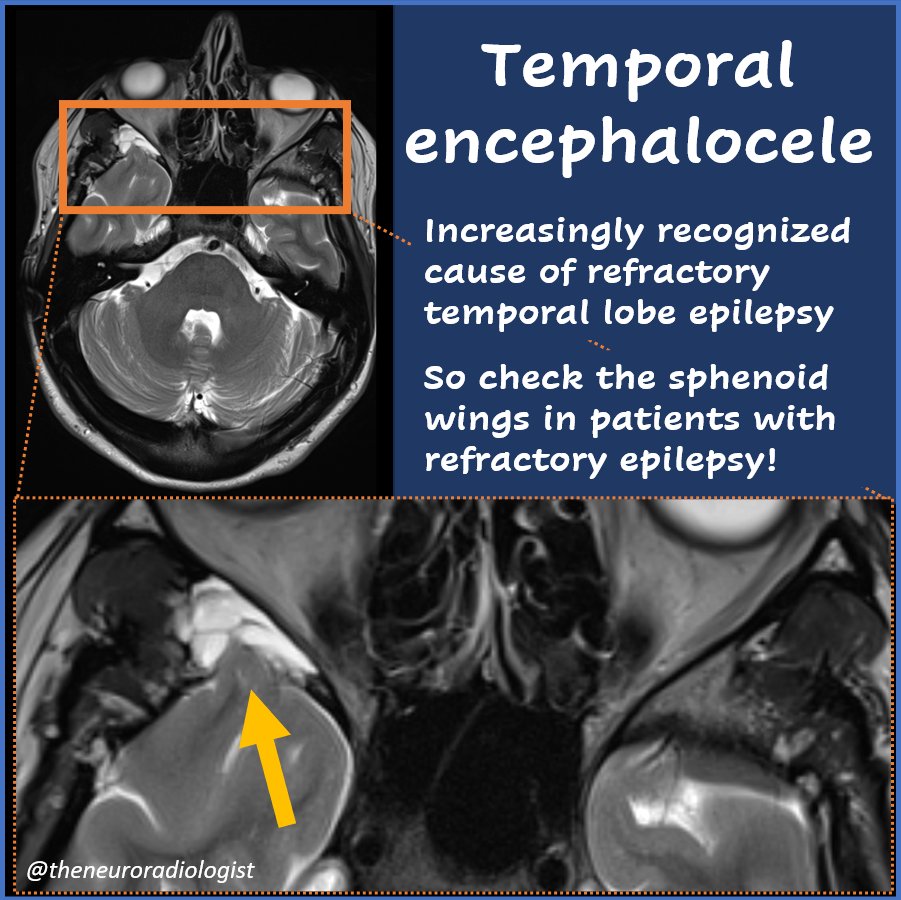 Always check the sphenoid wings on MRI in patients with refractory epilepsy! Temporal encephaloceles are an increasingly recognized cause of refractory epilepsy. If seizure activity can be localized to the encephalocele surgery has good outcome. #MedEd #radres #FOAMed #Radiology