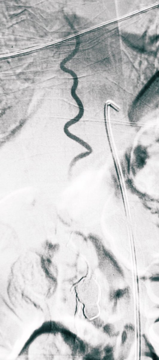 I have thoroughly examined and employed an underappreciated proactive test before embolizing SDAVM, SDAVF. The test demonstrates high sensitivity and specificity, aiding in pinpointing the exact location for the microcatheter to access.