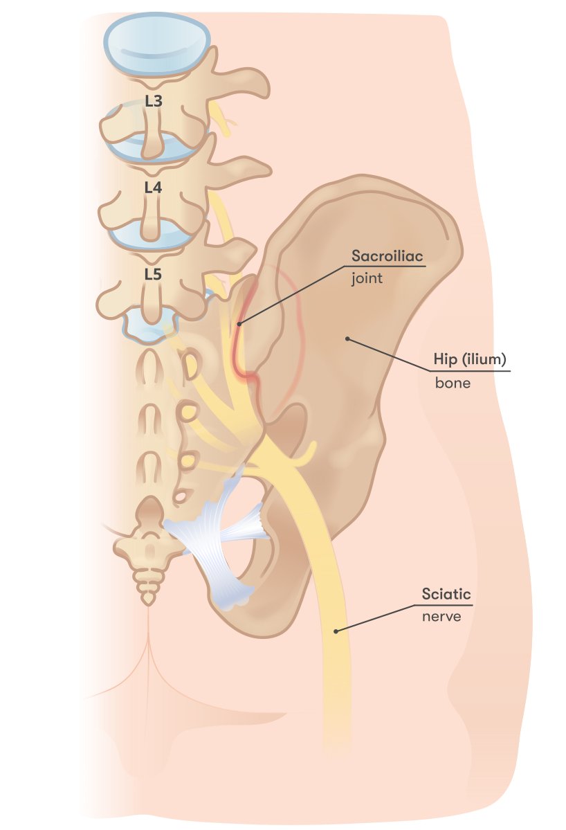 JayKarriMD's tweet image. #billingandcoding sacroiliac joint injections (SIJIs)

How I do it, upon review of CMS LCD criteria
*salient points and documentation pearls

CPT 27096 (50 modifier if bilateral)
ICD M46.1 (sacroiliitis, not classified)

go.cms.gov/3WR6dRb
go.cms.gov/3yygUQN