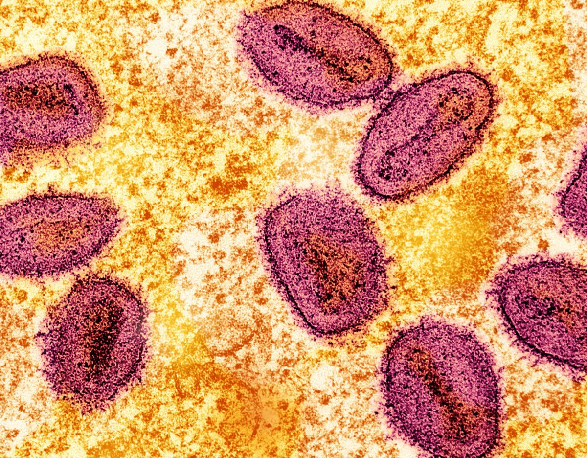 #Viruela del mono #Mpox. La declaración de emergencia sanitaria internacional es una llamada a la vigilancia y a la solidaridad. La mejor forma de controlar un brote es actuar en el origen y cuánto antes. 
Te lo cuento en microBIO:
microbioblog.es/viruela-del-mo…